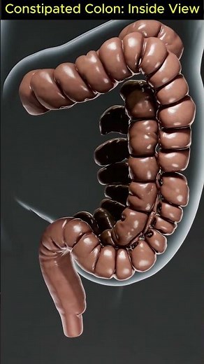 Inside the Colon: Ultra Slow-Motion 3D Animation of Constipated Stool Blockage | 09