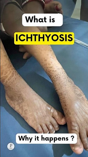 What's Behind Dry Scaly Skin? What is Ichthyosis ? #dermatology #skindisorders