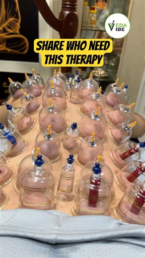 I Tried Cupping Therapy For Back Pain Relief