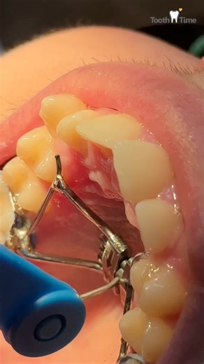 EXPANDER 101! 🦷‼️🤩 Tooth Time Family Dentistry