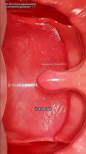 Tonsillectomy Surgery (3D Animation)#tonsillectomy #tonsilsurgery #ent #medical3d
