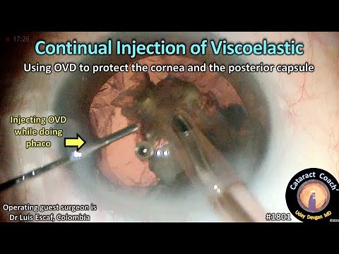 CataractCoach™1801: continual injection of viscoelastic