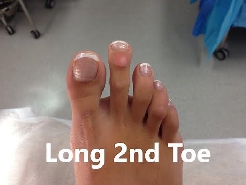 Second (2nd) Toe Longer than Big Toe *Home Treatment*