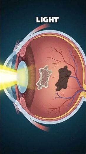 The truth about eye floaters #eyecare #shorts