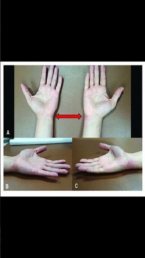 Fovea Sign: Quick Test for Ulnar Wrist Pain #wristpain #meded #anatomy #ATC #physiotherapy #ortho