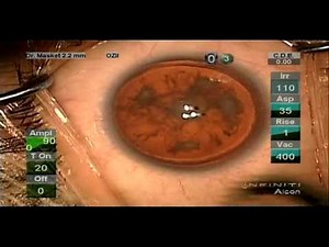 Artificial Iris Implant Surgery