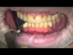 Papeles de articular Bausch de 200 micras con coloración progresiva