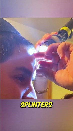 Removing Metal Splinters Safely