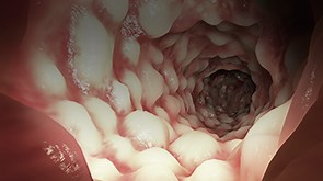 Reliability of Measuring Ileo-Colonic Disease Activity in Crohn's Disease by MR Enterography