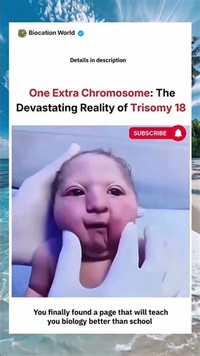 🧬 One Extra Chromosome: 👩‍⚕️ The Devastating Reality 🔬 of Trisomy 18 | Biocation World