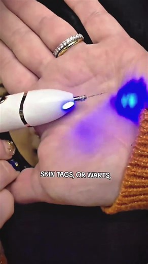 New Beauty Pen for Skin Tag and Milium Removal
