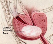 Prostate Cancer, causes, symptoms, diagnosis, stages and treatments