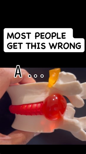 In your spine, the exiting nerve root Location is important! It exits at the same place each time. ⸻ That means something important: Pain you feel in your leg often comes from one nerve and not The other. ⸻ So if someone points to a disc and says “that’s the problem” without matching it to your exact pain pattern… 🚩 pause. ⸻ Now do you know which one is correct?? COMMENT “A” or “B” if you think you know!! The location of your pain matters. The path of the nerve matters. The anatomy matters. ⸻ G