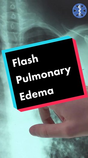 Understanding Flash Pulmonary Edema in EMS: Treatment and Prevention