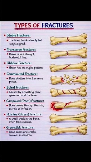 8 Types of Bone Fractures You Must Know 🦴🔥90% Students Forget These Fractures 😱