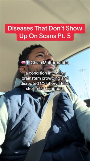 Imaging can be misleading because: • Tonsillar descent can be borderline yet still symptomatic • Measurements don’t reflect CSF dynamics • Supine MRI may reduce crowding seen when upright • Symptoms can result from flow obstruction, not just descent depth • Low CSF pressure (like from a leak) can create acquired Chiari People can have severe symptoms even when imaging is read as “mild” or “incidental.” Common symptoms include: 🤕 Occipital headaches (often positional or Valsalva-related) 🌀 Dizz