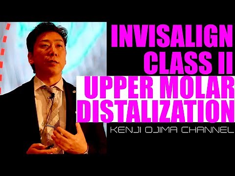 Invisalign Class II Upper Molar Distalization【インビザライン大臼歯遠心移動】
