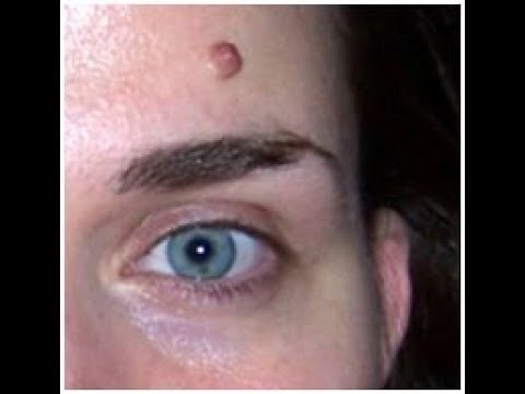 How to Remove Raised Moles / Wart & Mole Vanish