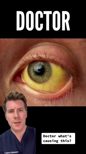 Jaundice explained in under 60seconds #fyp #jaundice #yelloweyes #gallstones #hepatitis #foryoupage #medical #health #healthinformation #liver #bilirubin #liverdisease #clinicalskills #medicalknowledge #healthinformation