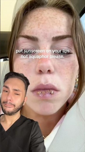 Lip Blisters From Aquaphor and Vaseline | Sunburn | MaximumSkin