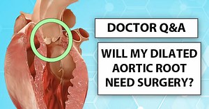 Doctor Q&A: “Will My Dilated Aortic Root Progress to Needing Surgery?” asks Desmond