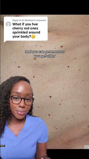 Cherry/Red Skin Growth (Cherry Angioma) and How To Treat It