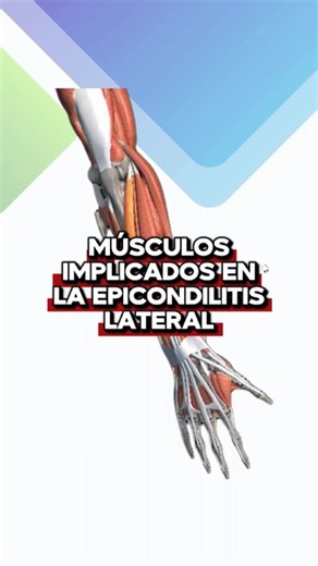 Repaso anatómico: Epicondilitis lateral La epicondilitis lateral compromete los músculos que tienen su origen en el epicóndilo lateral del húmero, responsables de la extensión y estabilización de la muñeca y los dedos. • Extensor cubital del carpo (ECU): extensión y desviación cubital de la muñeca. • Extensor común de los dedos (EDC): extensión de los dedos y de la muñeca. • Supinador: permite la supinación del antebrazo. • Extensor radial largo del carpo (ECRL): extensión y desviación radial de