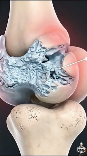 Osteoarthritis
