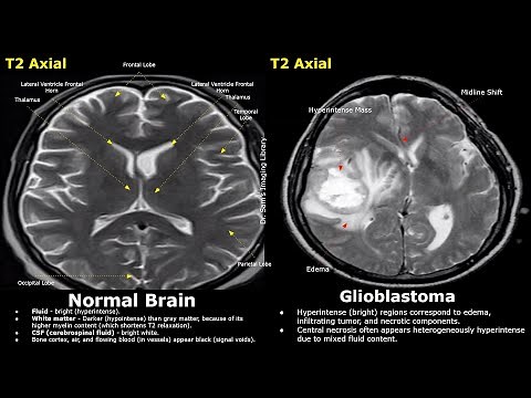 MRI Brain Normal Vs Glioblastoma T2 & FLAIR Imaging Findings | High Grade Aggressive Tumors