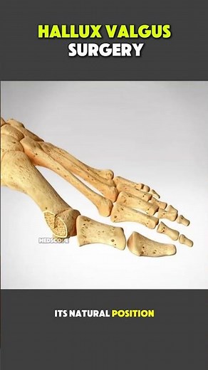 Hallux Valgus (Bunion) Surgery Explained | Step-by-Step Procedure #BunionSurgery #FootSurgery