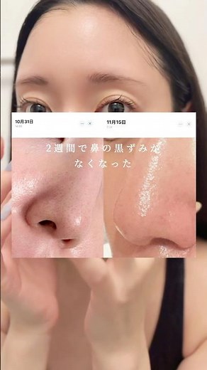 イソトレチノインは皮脂を抑える強いお薬で乾燥肌の方にはおすすめできません。取り入れたい場合はクリニックで相談を！ #美容 #毛穴