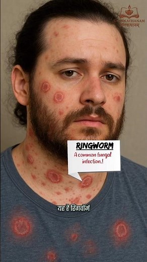 Ringworm explained |Class12th Biology! DS-6 #ringworm #class12biology #neet2026 #neet #gyankathanam