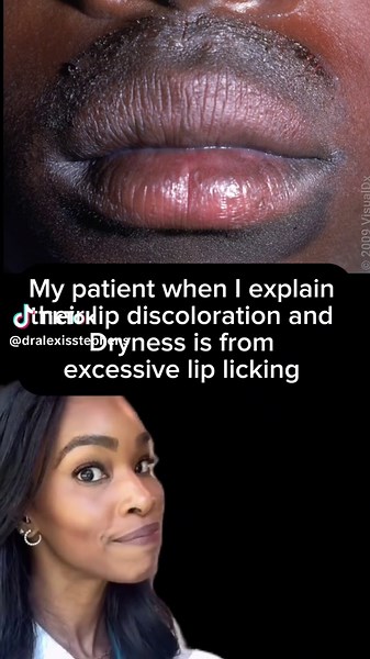 Effective Remedies for Chronic Lip Licking