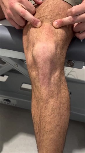 Dr. Tom Walters, DPT, OCS on Instagram: "💥𝐈𝐧𝐯𝐞𝐫𝐭𝐞𝐝 𝐉 𝐒𝐢𝐠𝐧💥 —— 📚The inverted J sign refers to the abnormal tracking pattern of the patella during active knee extension, where it shifts laterally before suddenly moving medially into the trochlear groove near terminal extension. This creates a reverse “J”-shaped path, visible when observing the patella from the front during quadriceps activation. 🔎This sign is often seen in individuals with patellofemoral joint instability, particu