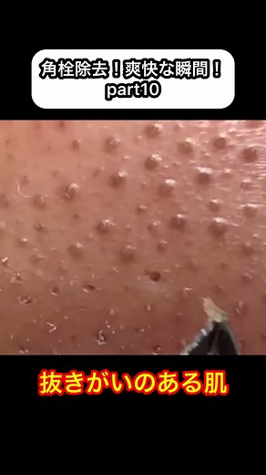 角栓抜きの仕事したい#角栓 #角栓除去 #角栓抜き #毛穴 #pimples #pimples_brufoli #blackhead #blackheads #blackheadsremoval #
