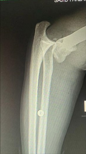 How to Reduce a Dislocated Elbow ? #Elbow #joint #dislocation #ortho #Arm #Forearm #réductions #Hand