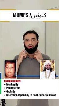 Mumps / کنوئیں | Exam Key Points | Dr Hafiz Atif | First Aid Made Easy Platform #FCPS #NRE #USMLE