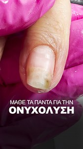 😱Τι είναι η Ονυχόλυση? Διάβασε⬇️⬇️⬇️ 🔔Διαχωρισμός της πλάκας του νυχιού από την βάση του, δημιουργώντας ένα λευκό ή κιτρινωπό χρώμα στην πλάκα του νυχιού. ⚠️Συναντώντας ονυχόλυση... αναμένουμε εγκλωβισμένη υγρασία, μούχλα & μύκητες! Γιατί Συμβαίνει; 1. 📛Αλλεργική αντίδραση Όταν μια ουσία προκαλεί ερεθισμό ή αλλεργική αντίδραση, το επιθήλιο της κοίτης του νυχιού, κερατινοποιείται για να προστατεύσει τη βάση & τη μήτρα του νυχιού. Τα υλικά που συνήθως είναι υπεύθυνα για ερεθισμούς & αλλεργίες ε