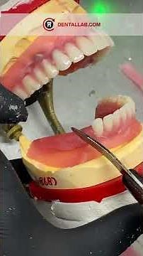 #NeoSnap™ Implant-Retained Dentures | Locator Attachment Full-Mouth #Restoration #dentallab