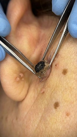 blackhead removal #blackhead #asmr #satisfyingvideo