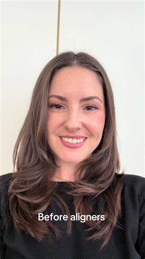 Before, and after 4 weeks of clear aligners! Can you see them moving? 🥰#invisalign #clearaligners #beforeandafter #braces #bracesprogress