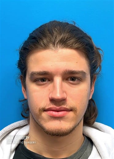 Braces are off for this young man after Jaw Surgery for severe malocclusion. | Jaw Surgery Dallas