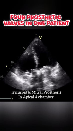 Four Prosthetic Valves #cardiology #echo