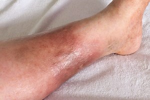 Infectious cellulitis: what is it? Diagnosis and treatment