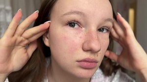 Close-up of teenage girl showing her skin swelling freckles problem skin adolescence self-care