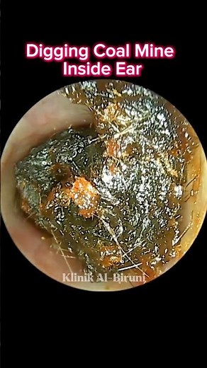 DIGGING Coal Mine Inside Ear