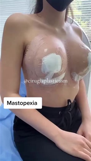 Understanding Mastopexy: Benefits and Recovery