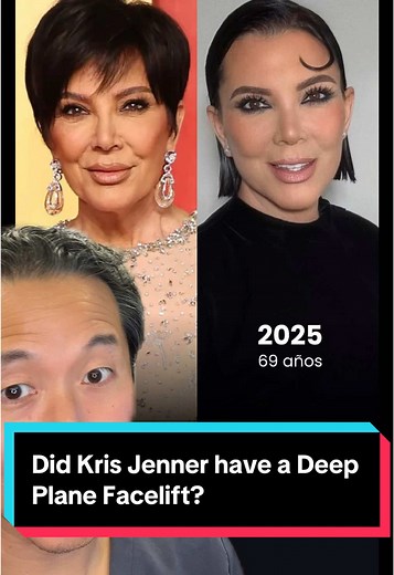 Kris Jenner's Deep Plane Facelift: Truth Revealed