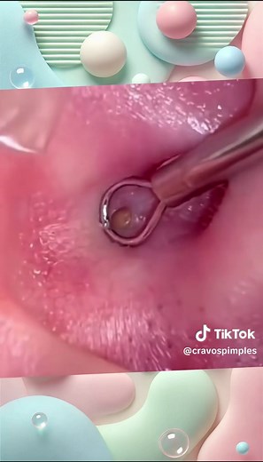 Ear Pimple #earpimple #foryoupage #foryou #viralvideos #pimples