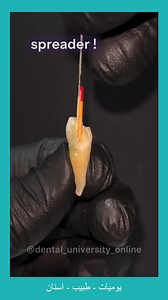 Remember In lateral condensation technique_ what will increase your success in obturation is the use of more gutta and less sealer. #endodontic | Dentist Sufyan T. Algahdari